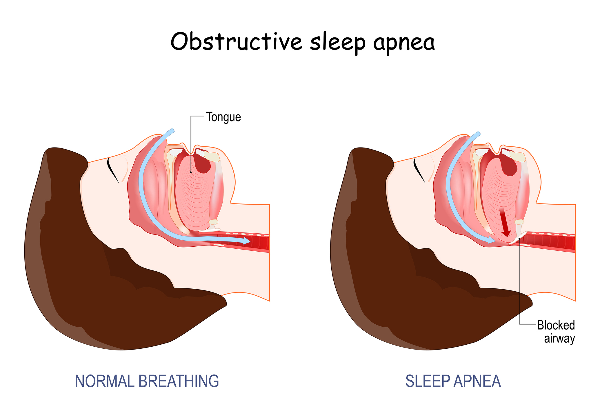 snoring and sleep apnea Archives - Comprehensive Sleep Care