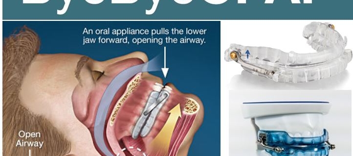 Oral Appliance Therapy